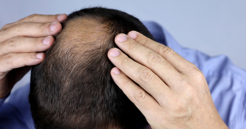סובלים משיער דליל ונשירה? הכירו את הפתרונות הכי יעילים